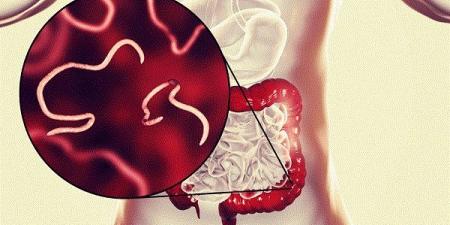 نصائح لحماية طفلك من الإصابة بالديدان الدبوسية - عرب فايف
