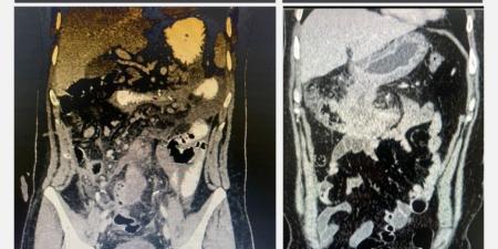 استئصال ورم يزن 5 كيلوغرامات من المعدة والقولون لأربعيني - عرب فايف