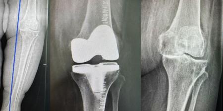 مستشفى الدكتور سليمان الحبيب بالخبر يُجري عملية دقيقة بالروبوت الجراحي لإعادة قدرة المشي لمراجعة "تسعينية" - عرب فايف