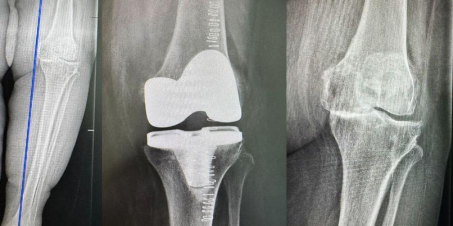 مستشفى الدكتور سليمان الحبيب بالخبر يُجري عملية دقيقة بالروبوت الجراحي لإعادة قدرة المشي لمراجعة "تسعينية" - عرب فايف